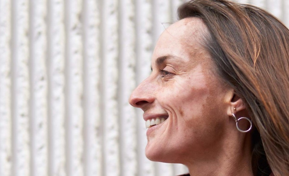 A side profile of a woman with Vitiligo