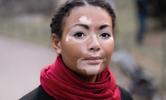 A young woman with Vitiligo affecting parts of her face, standing outside wearing a bright red scarf.